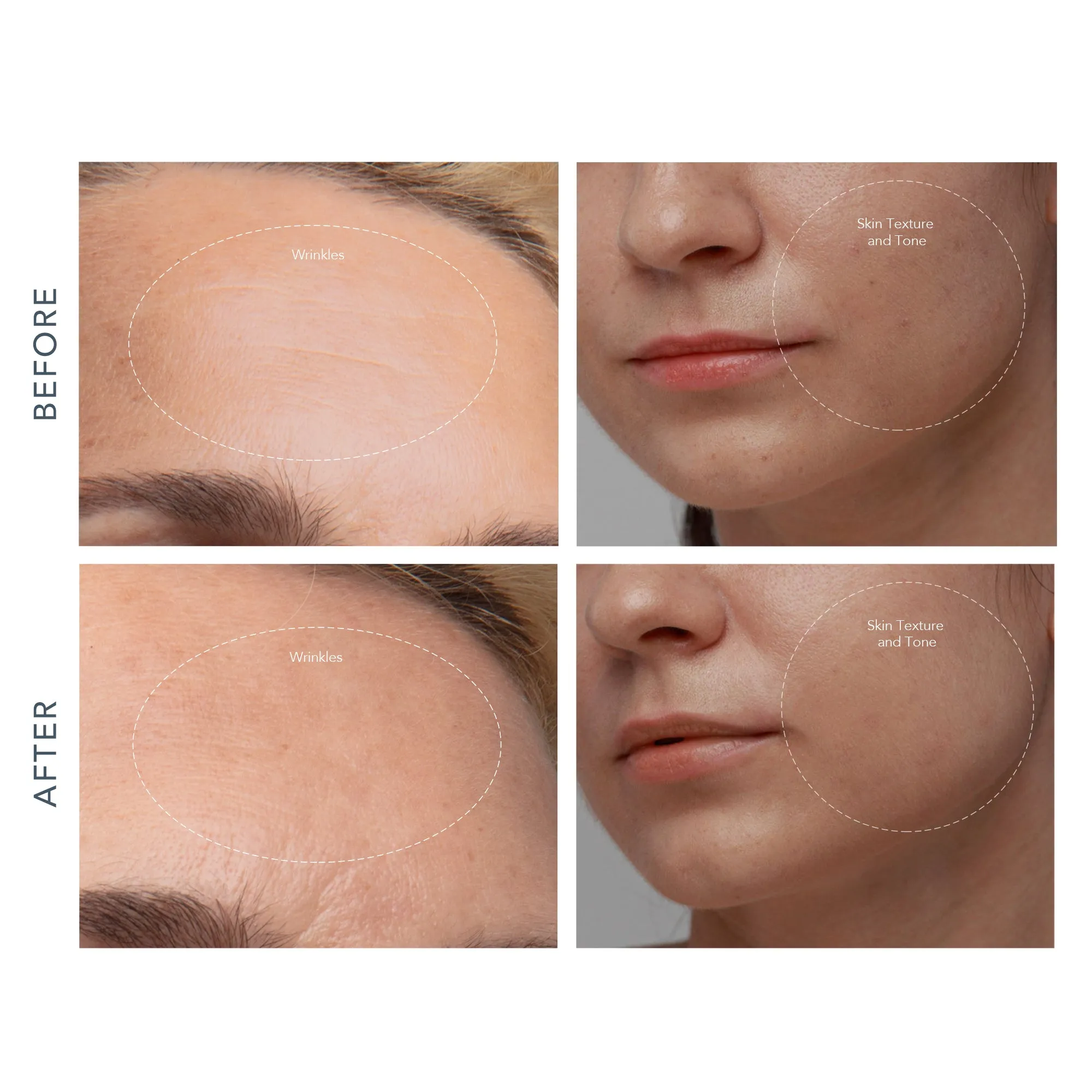 Kiwi Derma | Microdermoabrasin Con Dia